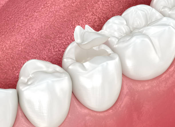 Dental Inlays and Onlays in Bismarck, MO